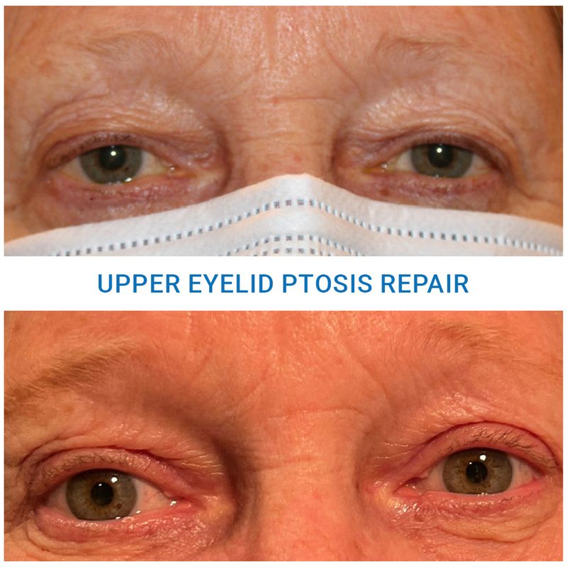 Oculoplastic Nashua Oculoplastic Surgery Manchester Medical Eye