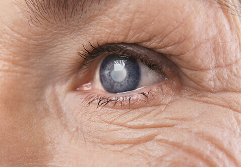 Close up of eye affected by catarct