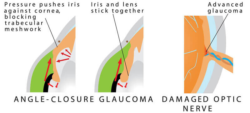 Closed Angle Glaucoma diagram