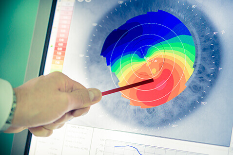 Corneal topography on monitor