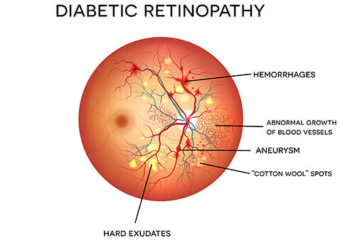 Diabetic Retinopathy Diagram