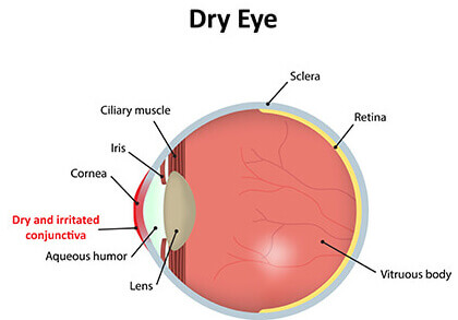 Dry Eye Diagram