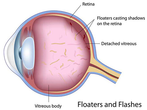 Diagram of Floaters in the Eye