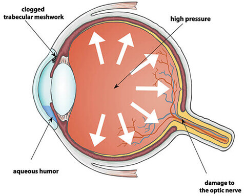 Diagram of Glaucoma Pressure