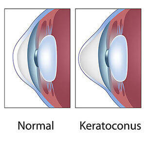 Normal cornea vs Keracotonus diagram