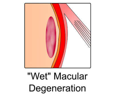 Wet macular degeneration diagram