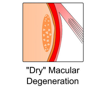 Dry Macular Degeneratno Diagram