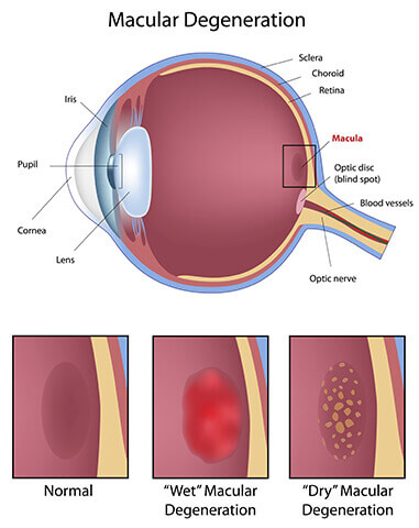 Macular Degeneration Manchester Amd