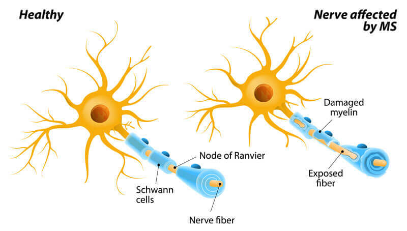Difference Healthy and Affected Nerves