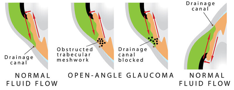 open angle glaucoma diagram