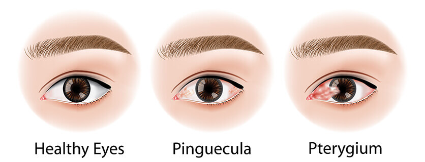 Pinguecula pterygium diagram