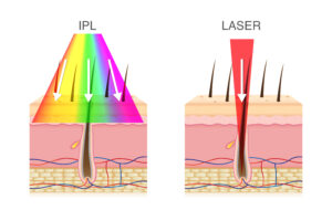 diagram of IPL and Laser skin treatment