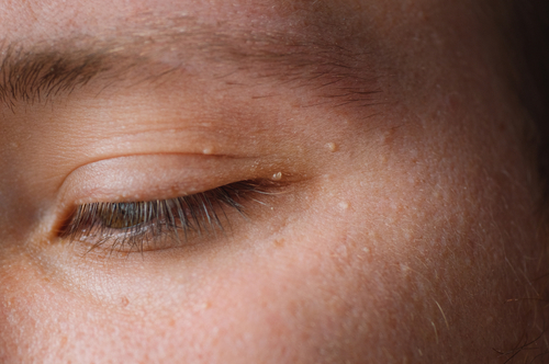 Eyelid Lesions Nashua Eyelid Cancer Manchester Medical Eye Center