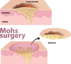 diagram of what Mohs surgery treats