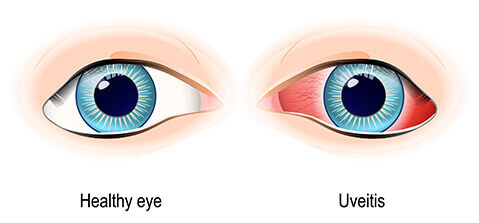 Uveitis Diagram